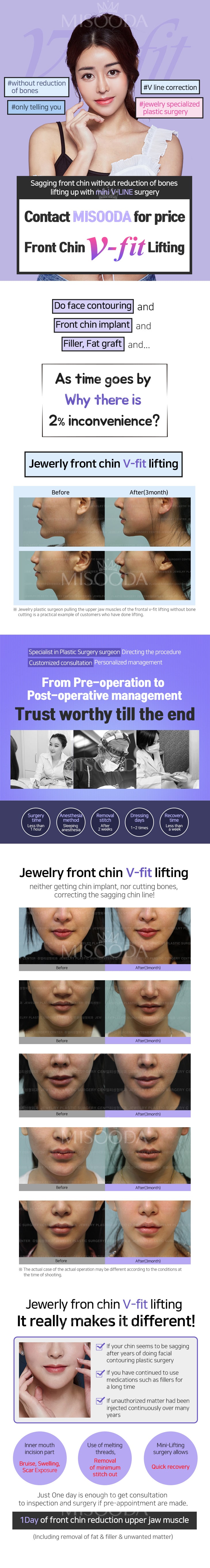Front Chin V-fit Lifting (Contact MISOODA for price)