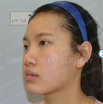 Facial Contouring with liposuction
