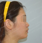 Facial Liposuction & Thread Lift