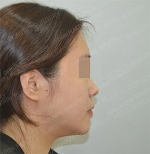 Facial Liposuction & Thread Lift