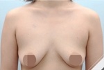 Breast Augmentation, Breast Lifting Surgery