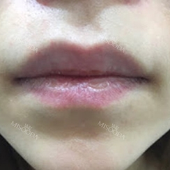 Lip(corner) filler injection