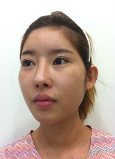 Accusculpt, Cheekbone Reduction, Lateral Canthoplasty