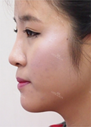 Forehead fat grafting + Rhinoplasty