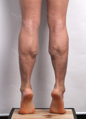 Calf muscle reduction