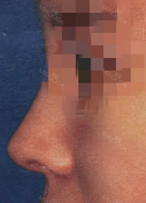 Beautiful Nose revision with Topface via Misooda.com