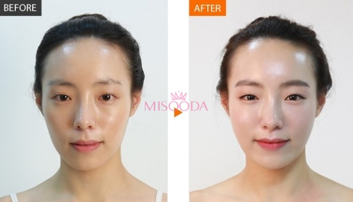 Korea facelift lifting before and after — MISOODA verified patient