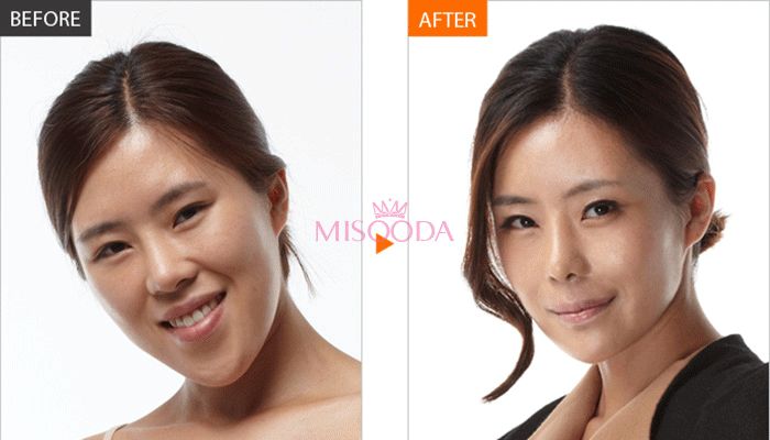 Korea liposuction contouring before and after — MISOODA verified patient