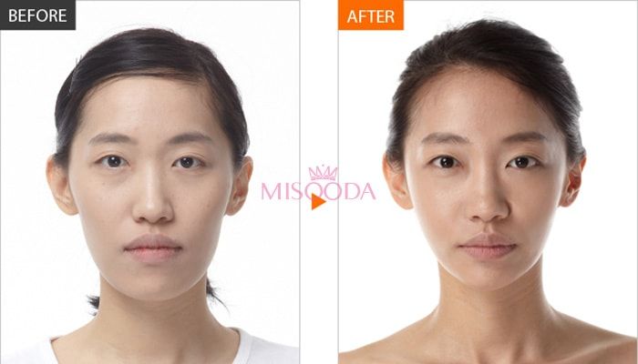 Korea anti-aging stem cell before and after — MISOODA verified patient