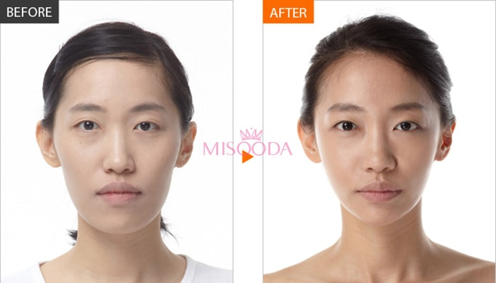 Korea anti-aging stem cell before and after — MISOODA verified patient