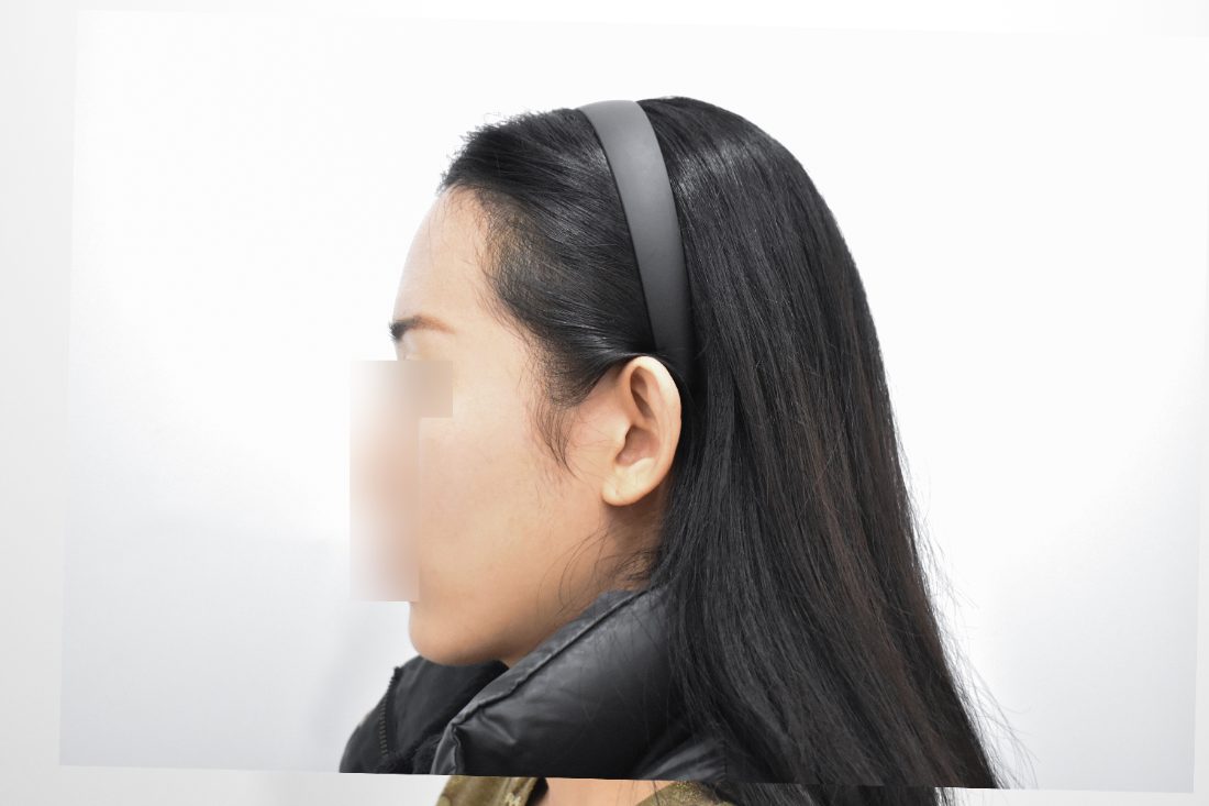 Patient 1 forehead implant after — side view (Singapore)