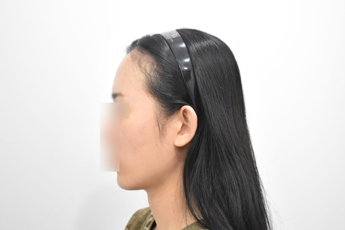 Patient 1 forehead implant before — side view (Singapore)