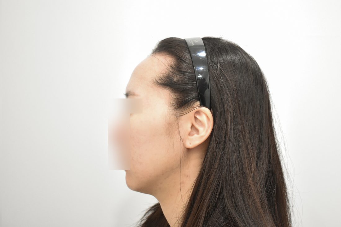 Patient 2 forehead implant before — side view (Singapore)