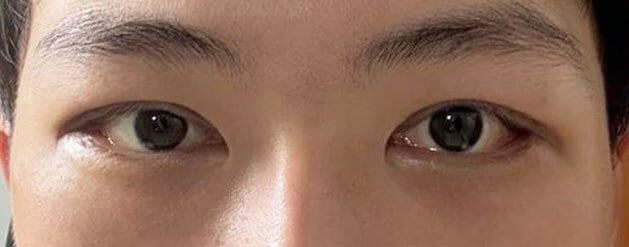 After — Returning Plastic Surgery