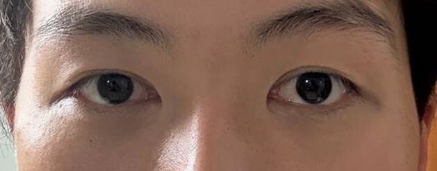 Before — Returning Plastic Surgery