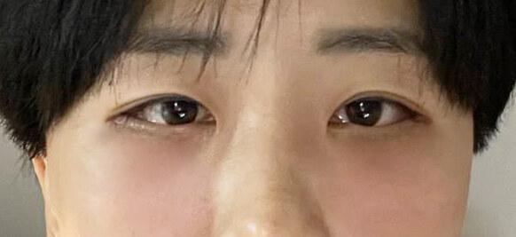 After — Returning Plastic Surgery