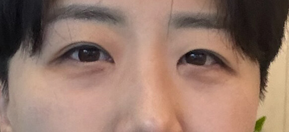 Before — Returning Plastic Surgery