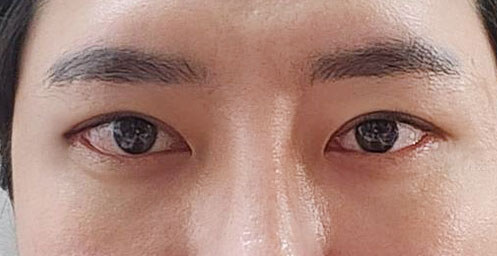 After — Returning Plastic Surgery