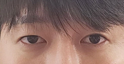 Before — Returning Plastic Surgery