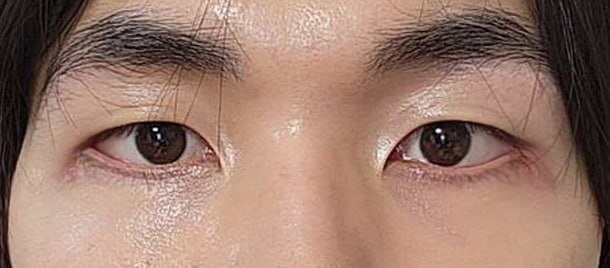 After — Returning Plastic Surgery