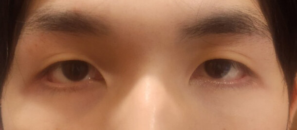 Before — Returning Plastic Surgery
