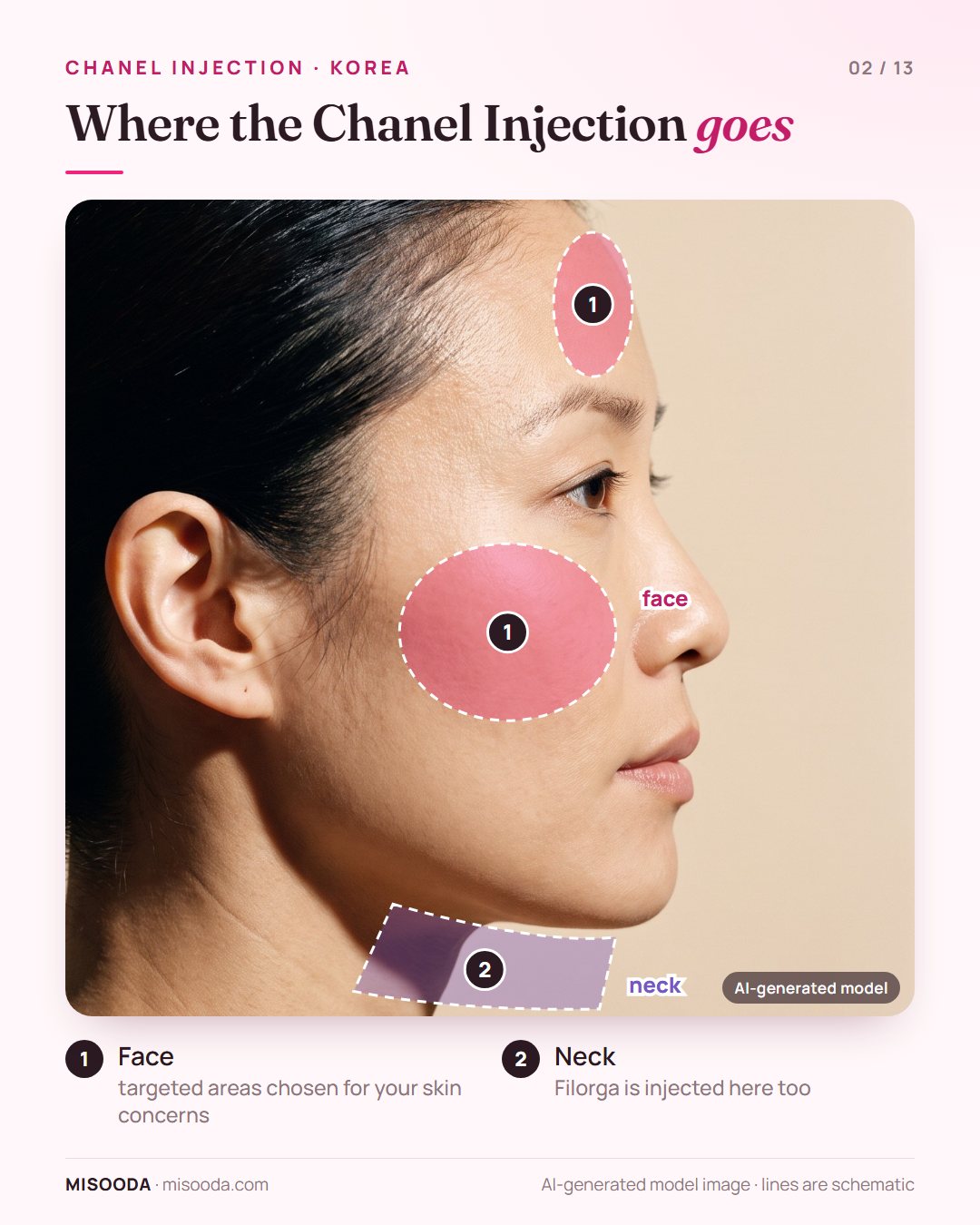 Chanel Injection treatment areas shown on a side profile: targeted areas of the face and the neck, treatment usually no more than 20 minutes