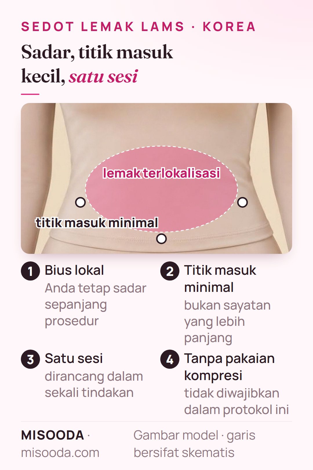 Cara kerja sedot lemak LAMS di Korea: bius lokal dalam keadaan sadar, titik masuk minimal di sekitar lemak terlokalisasi, satu sesi, tanpa pakaian kompresi