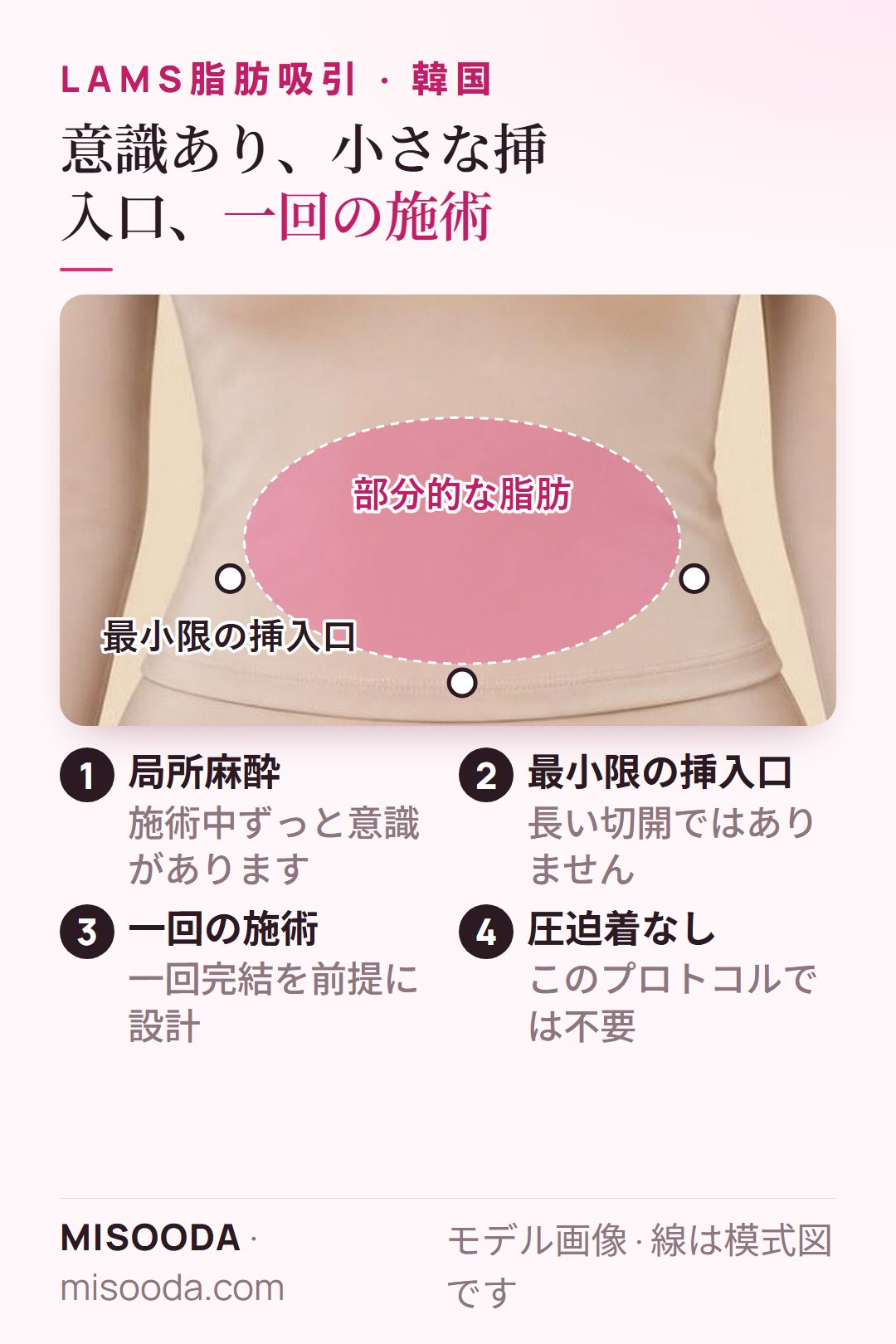 韓国 LAMS脂肪吸引の仕組み:意識のある局所麻酔、部分的な脂肪の周りの最小限の挿入口、一回の施術、圧迫着なし