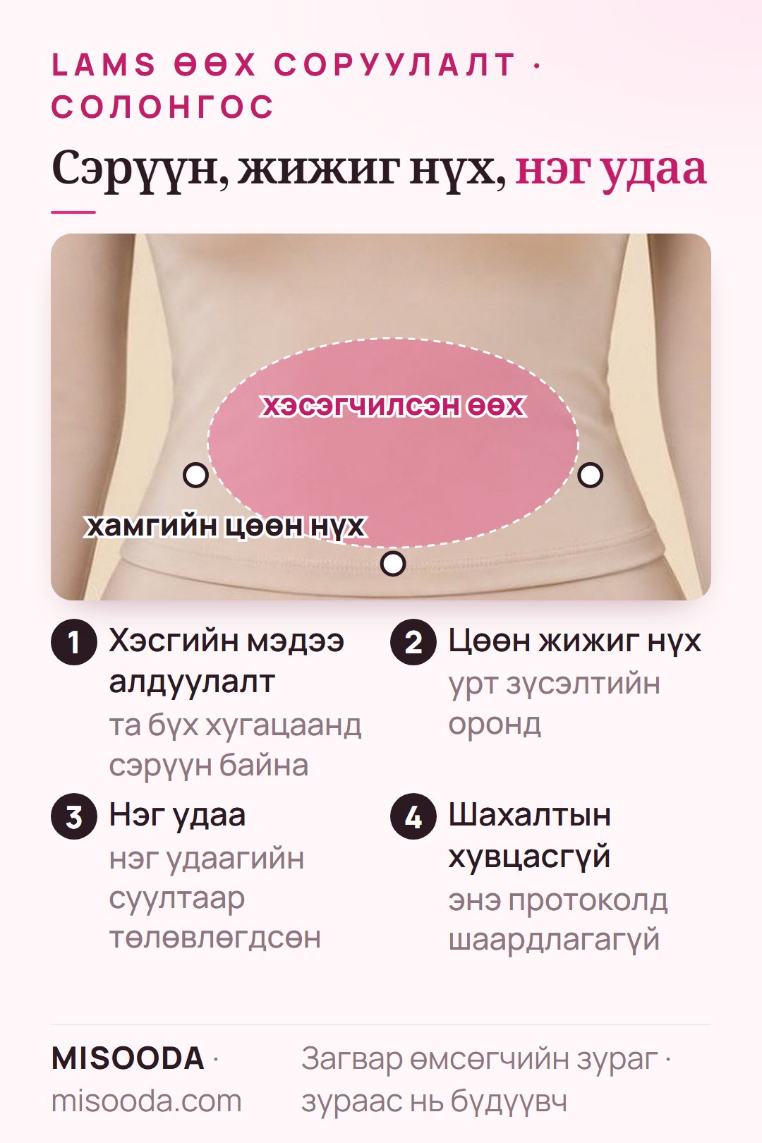 LAMS өөх соруулалт хэрхэн хийгддэг вэ: сэрүүн үед хэсгийн мэдээ алдуулалт, хэсэгчилсэн өөхний эргэн тойронд цөөн жижиг нүх, нэг удаа, шахалтын хувцасгүй