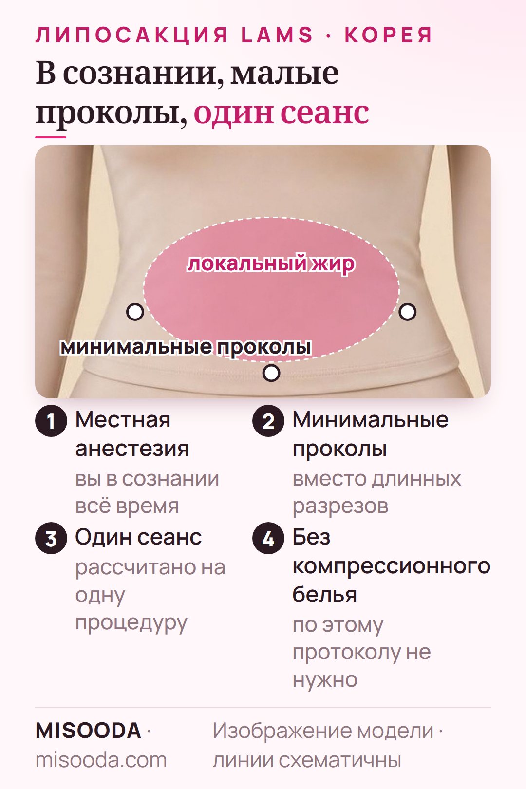 Как работает липосакция LAMS: местная анестезия, пациент в сознании, минимальные проколы вокруг локального жирового отложения, один сеанс, без компрессионного белья