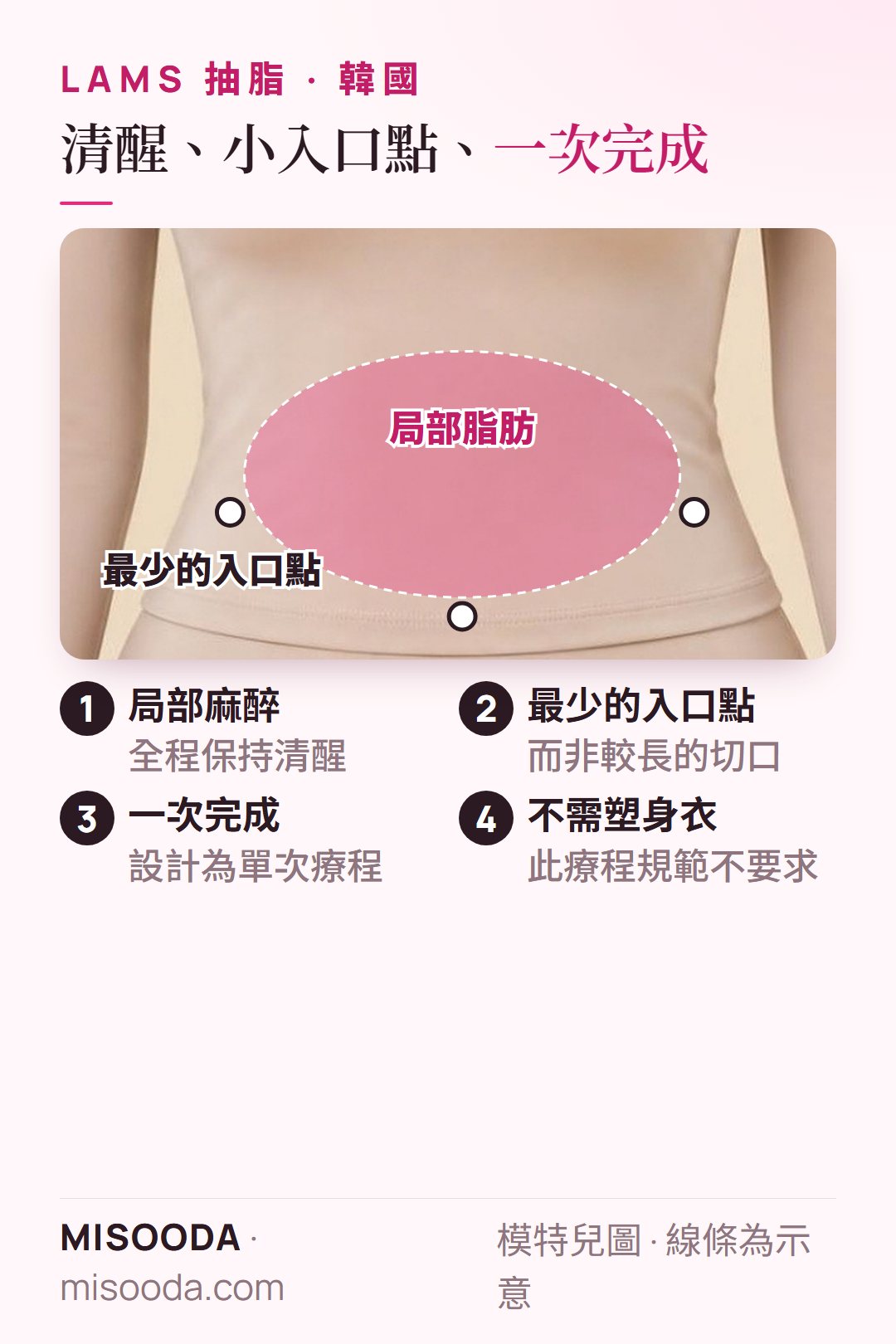 韓國 LAMS 抽脂如何進行:清醒狀態下局部麻醉、在局部脂肪周圍以最少入口點處理、一次完成、不需塑身衣