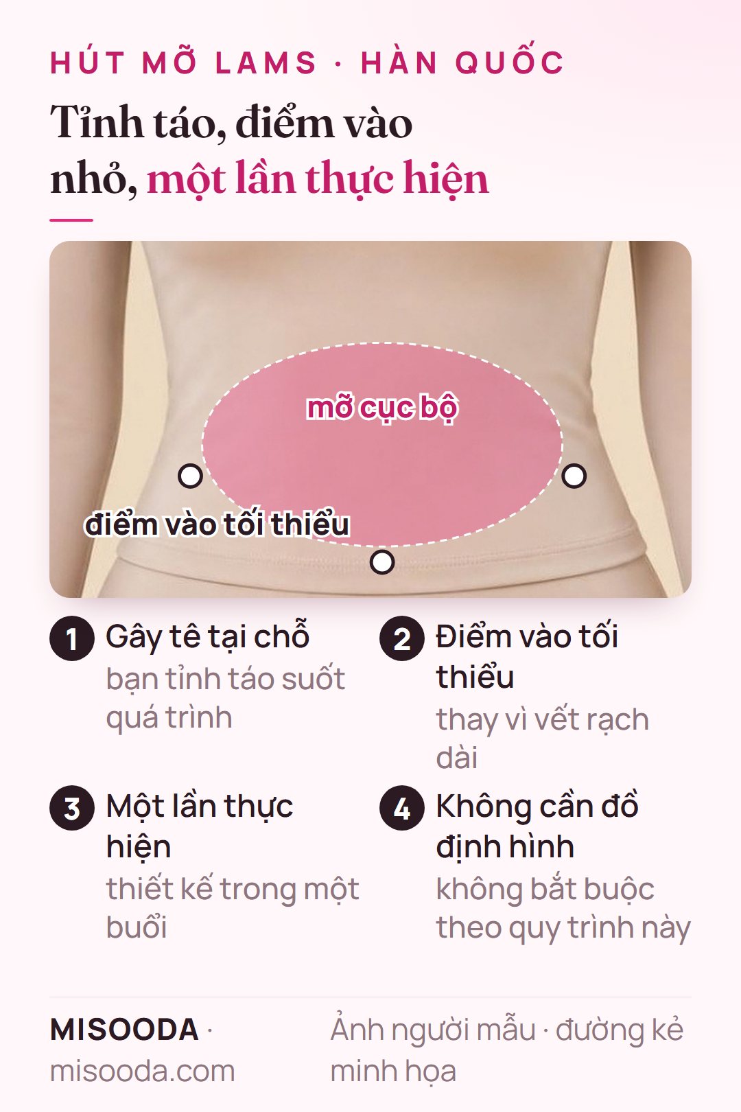 Cách hút mỡ LAMS tại Hàn Quốc hoạt động: gây tê tại chỗ khi vẫn tỉnh táo, điểm vào tối thiểu quanh vùng mỡ cục bộ, một lần thực hiện, không cần đồ định hình