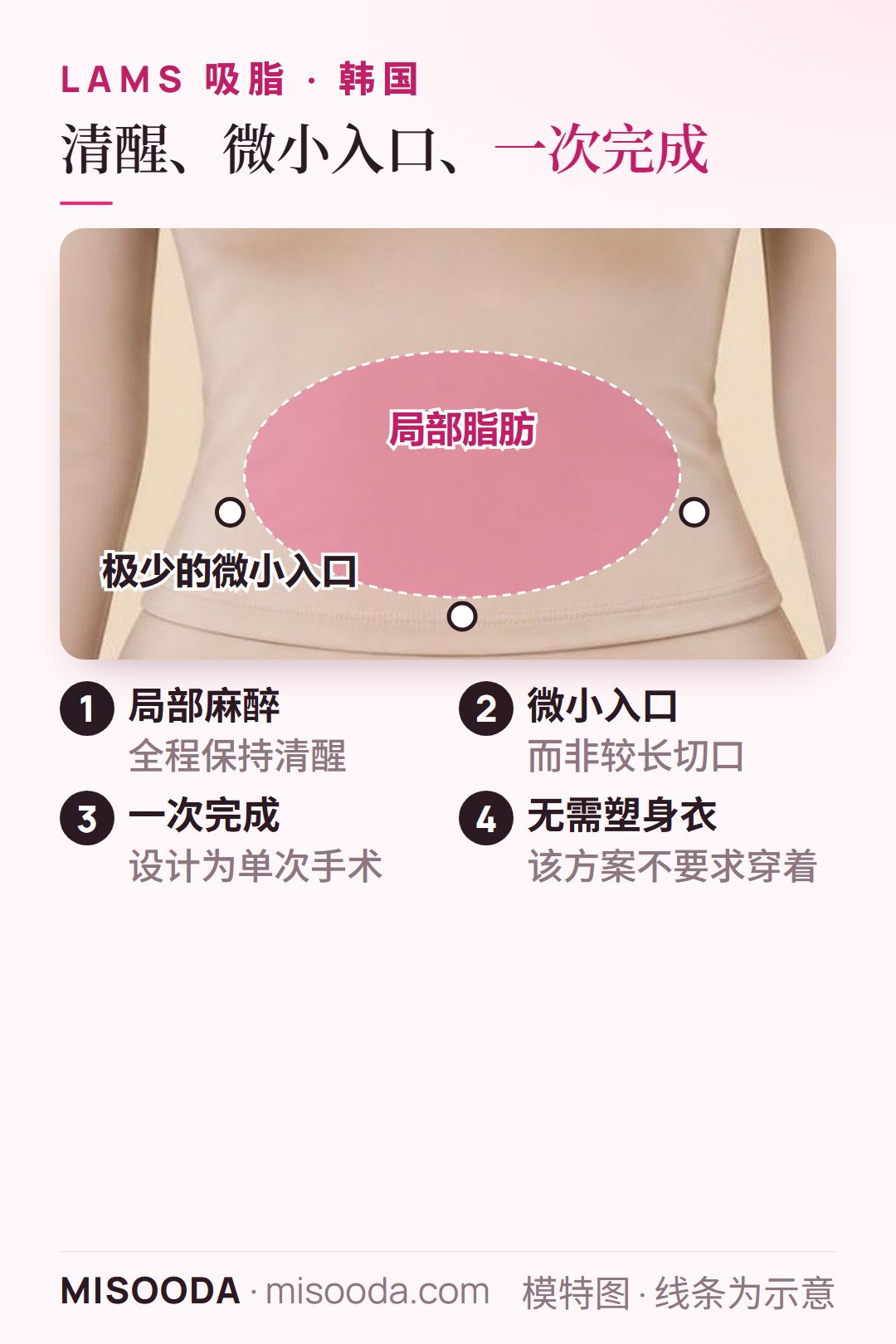 韩国 LAMS 吸脂原理:清醒状态下局部麻醉,在局部脂肪堆积周围做极少的微小入口,一次完成,无需塑身衣
