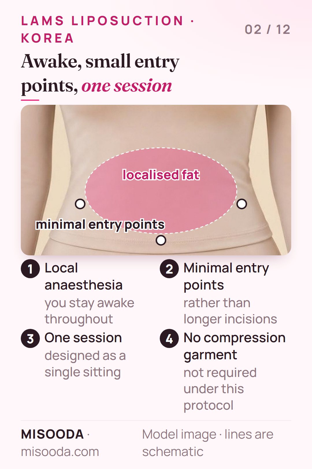 How LAMS liposuction works: local anaesthesia while awake, minimal entry points around a localised fat deposit, one session, no compression garment
