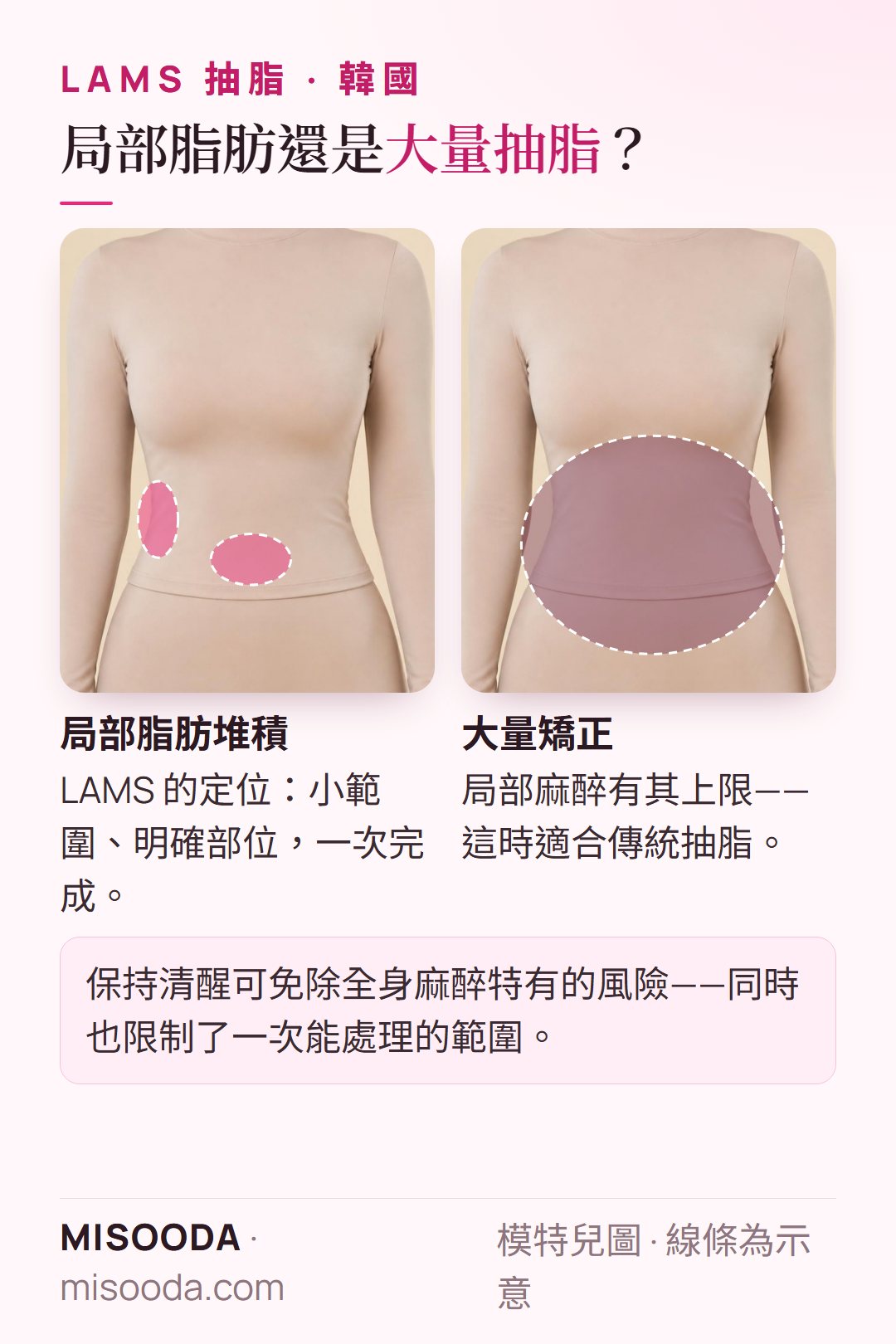 韓國 LAMS 抽脂適合局部脂肪堆積;大量矯正則需傳統抽脂,因為局部麻醉限制了治療範圍