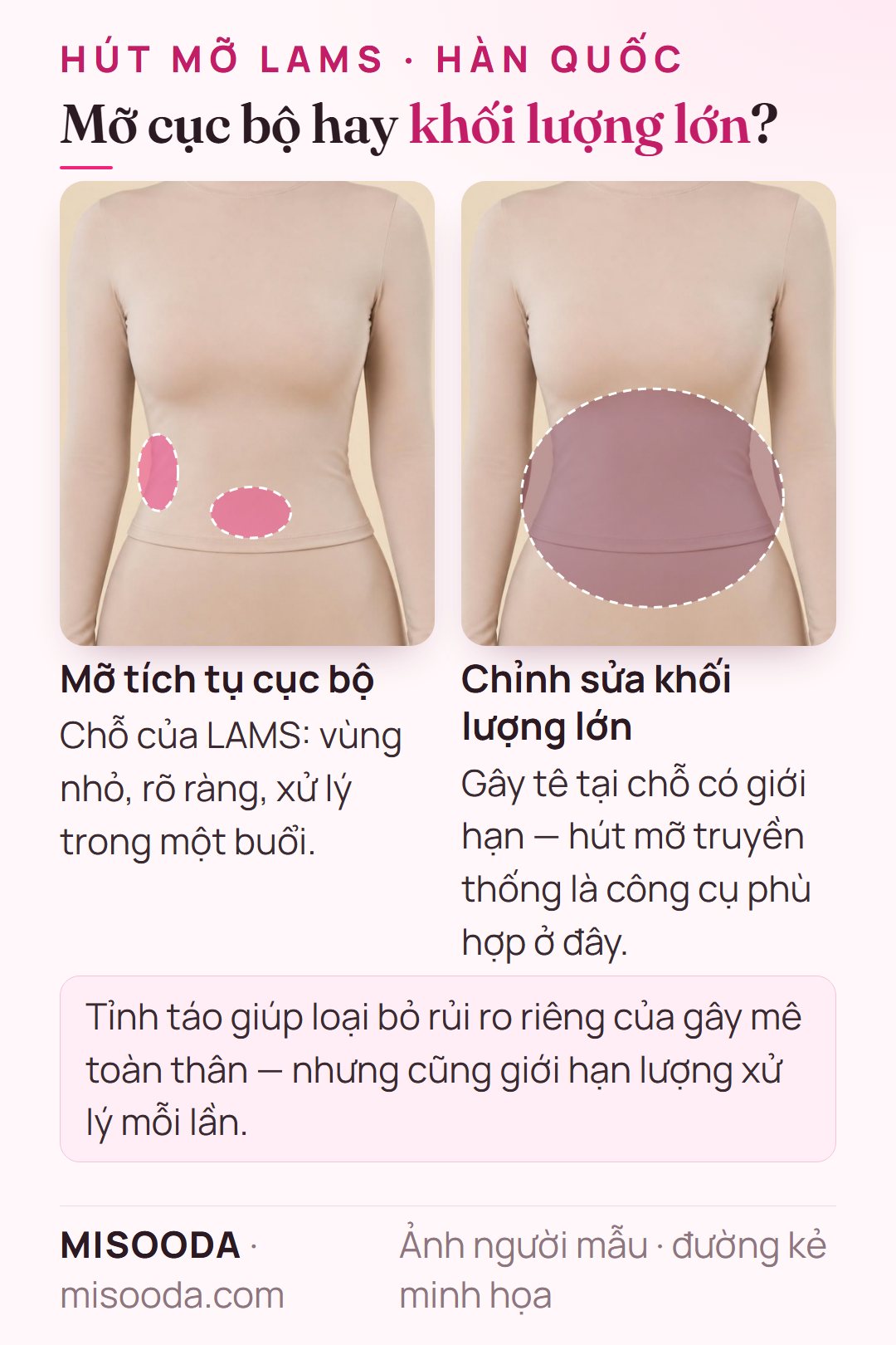 Hút mỡ LAMS hợp với mỡ tích tụ cục bộ; chỉnh sửa khối lượng lớn cần hút mỡ truyền thống vì gây tê tại chỗ giới hạn lượng xử lý