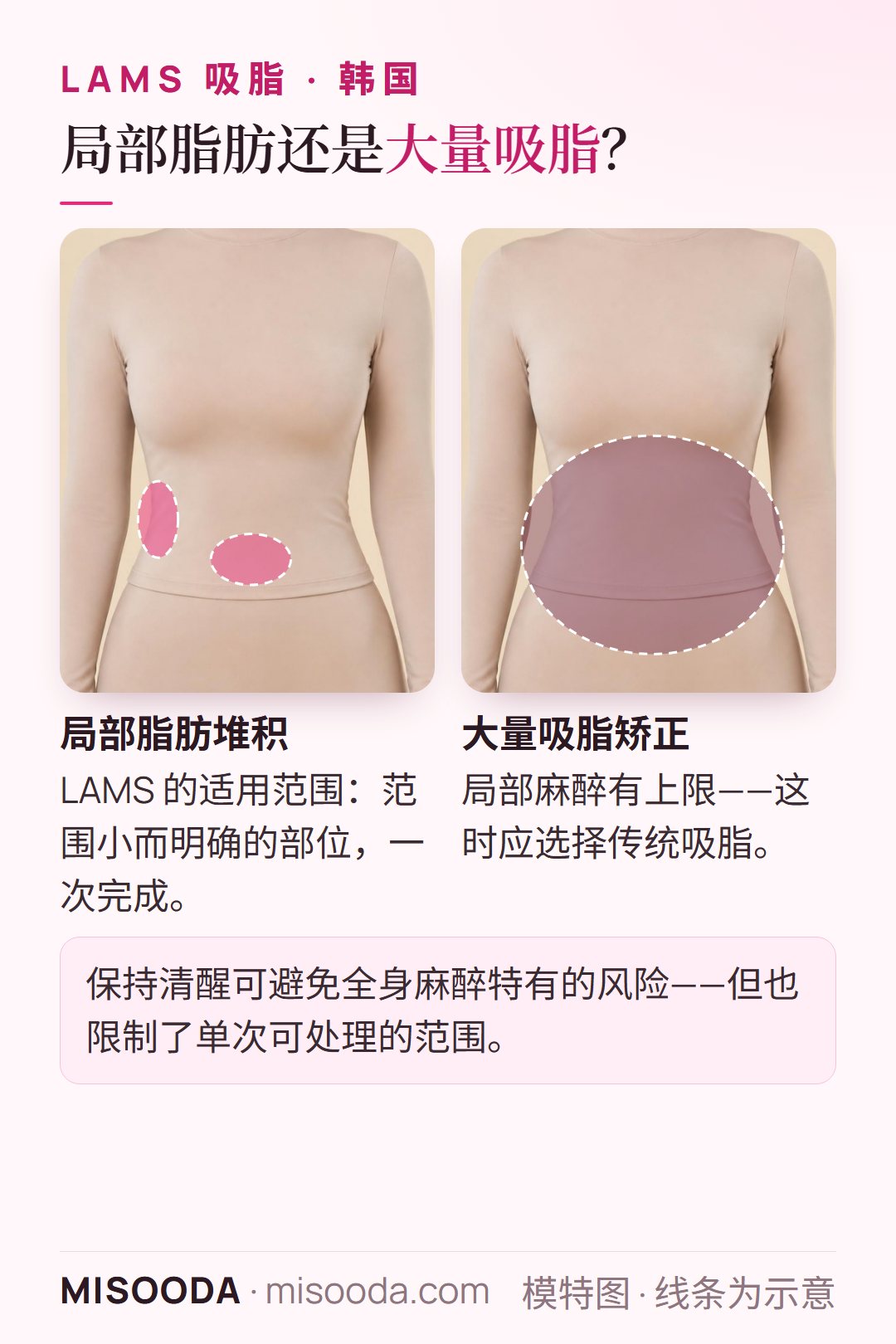 韩国 LAMS 吸脂适合局部脂肪堆积;大量吸脂矫正需要传统吸脂,因为局部麻醉限制了单次处理范围