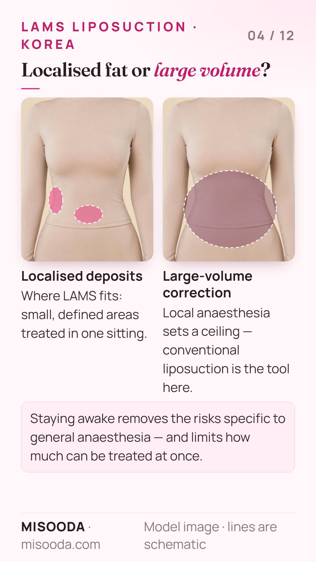LAMS liposuction suits localised fat deposits; large-volume correction needs conventional liposuction because local anaesthesia limits treatment