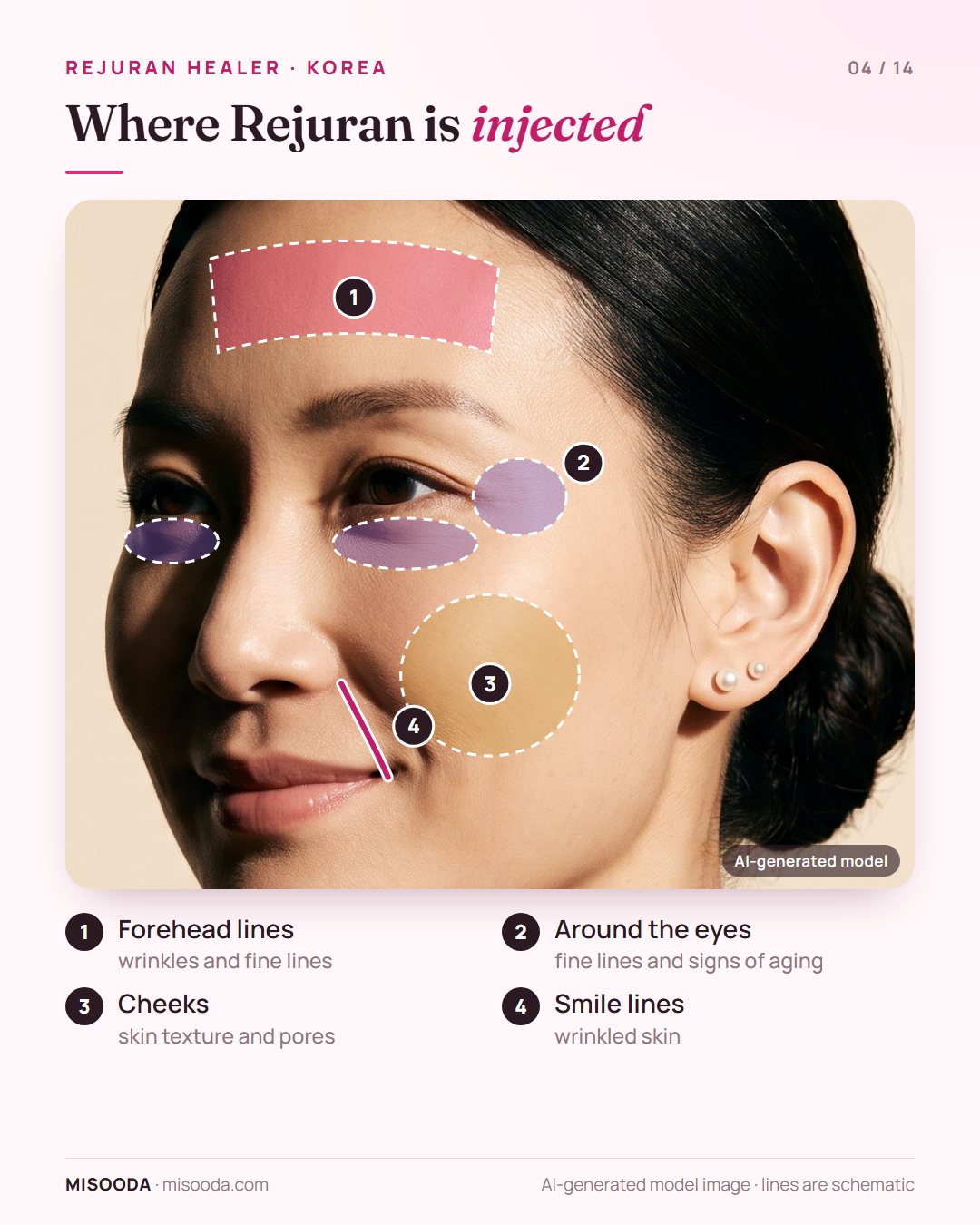 Rejuran Healer treatment areas on a three-quarter face: forehead lines, around the eyes, cheeks and smile lines where wrinkles and signs of aging show