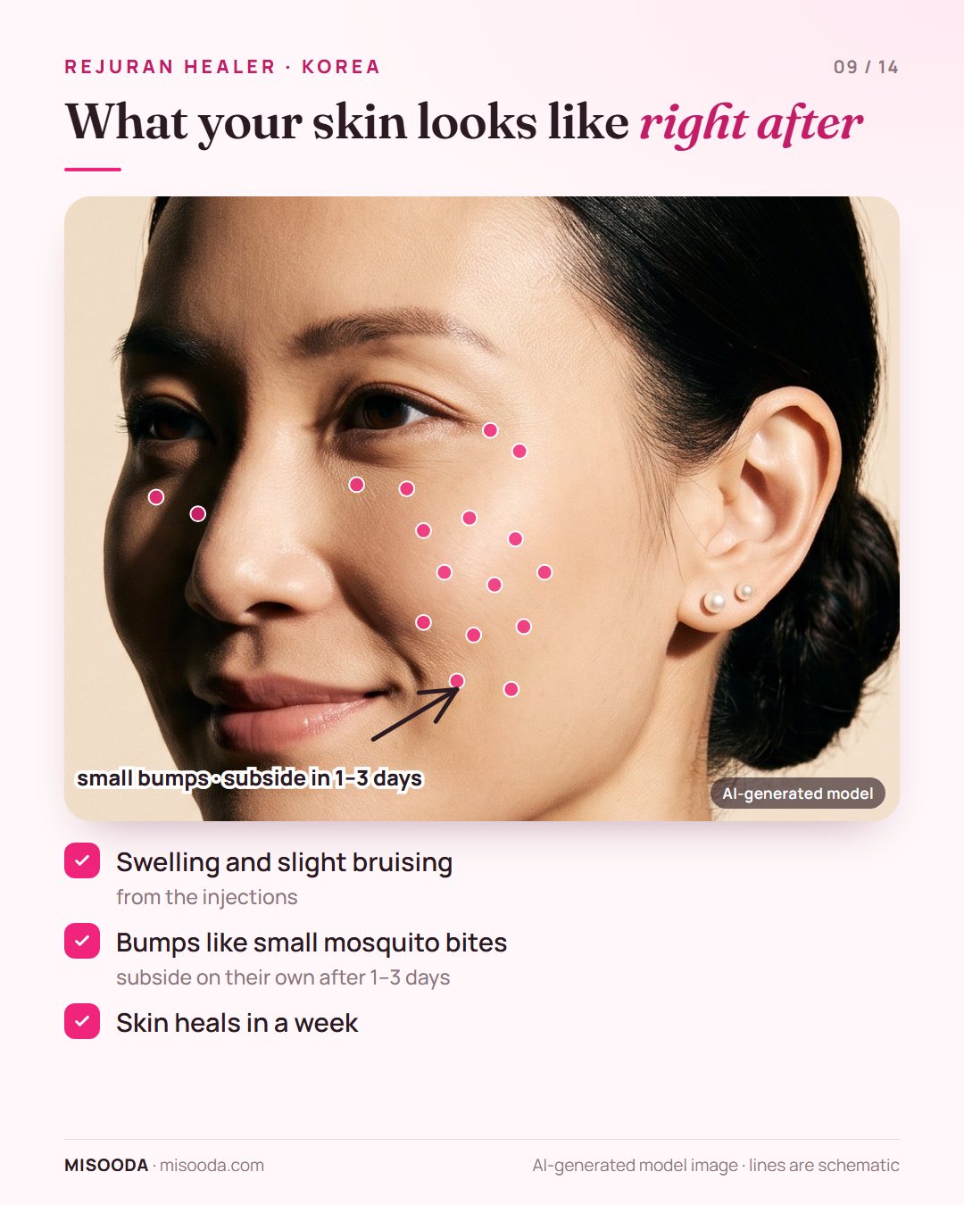 After Rejuran Healer: swelling and small bumps like mosquito bites at the injection spots that subside on their own after 1–3 days
