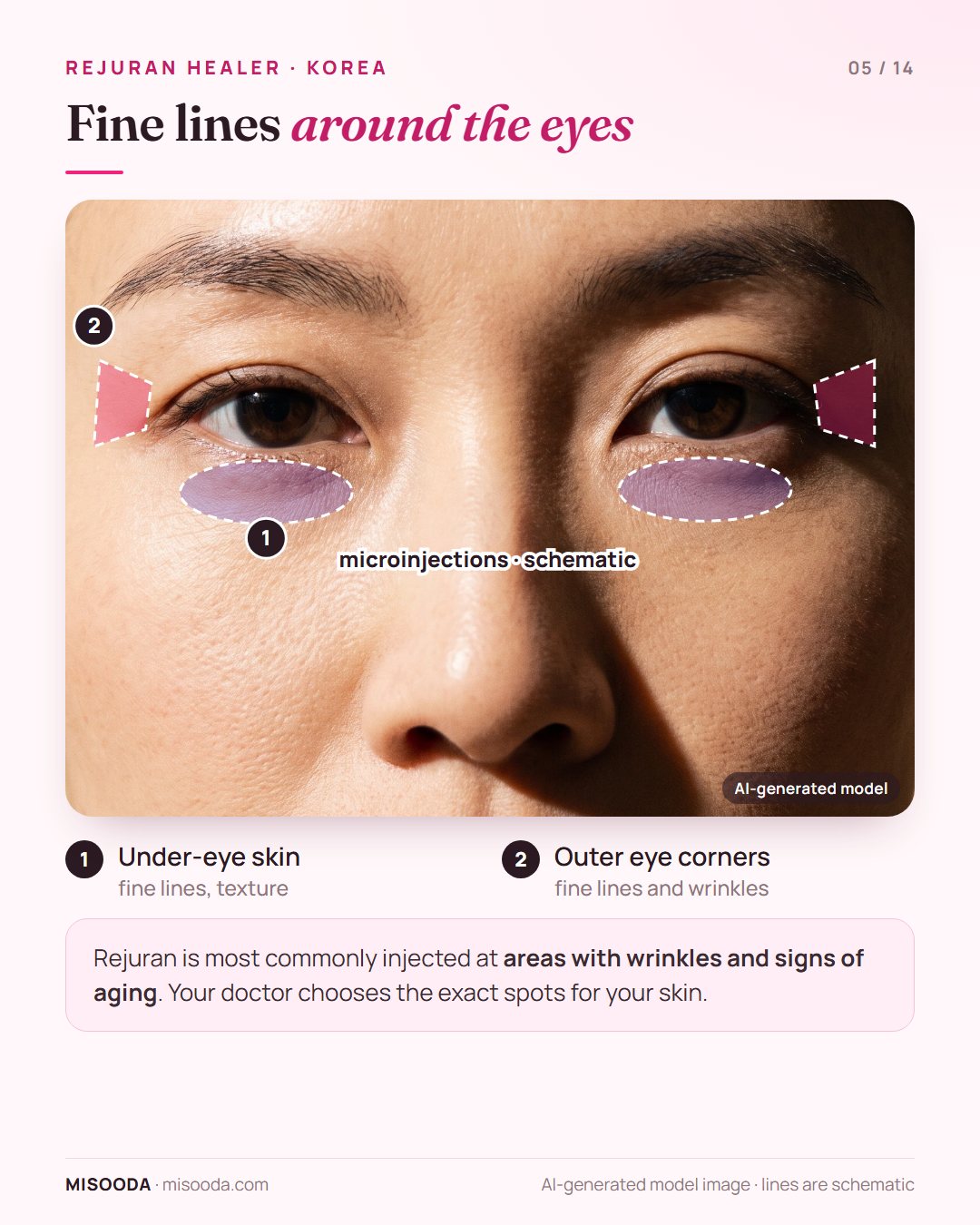 Rejuran Healer around the eyes: microinjections for under-eye skin and outer eye corner fine lines, chosen by the doctor for signs of aging