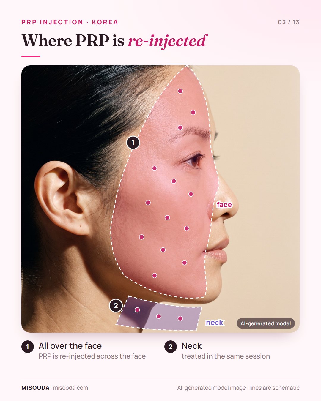 PRP injection areas on a side profile: platelet-rich plasma re-injected all over the face and the neck in one session of about 20 minutes