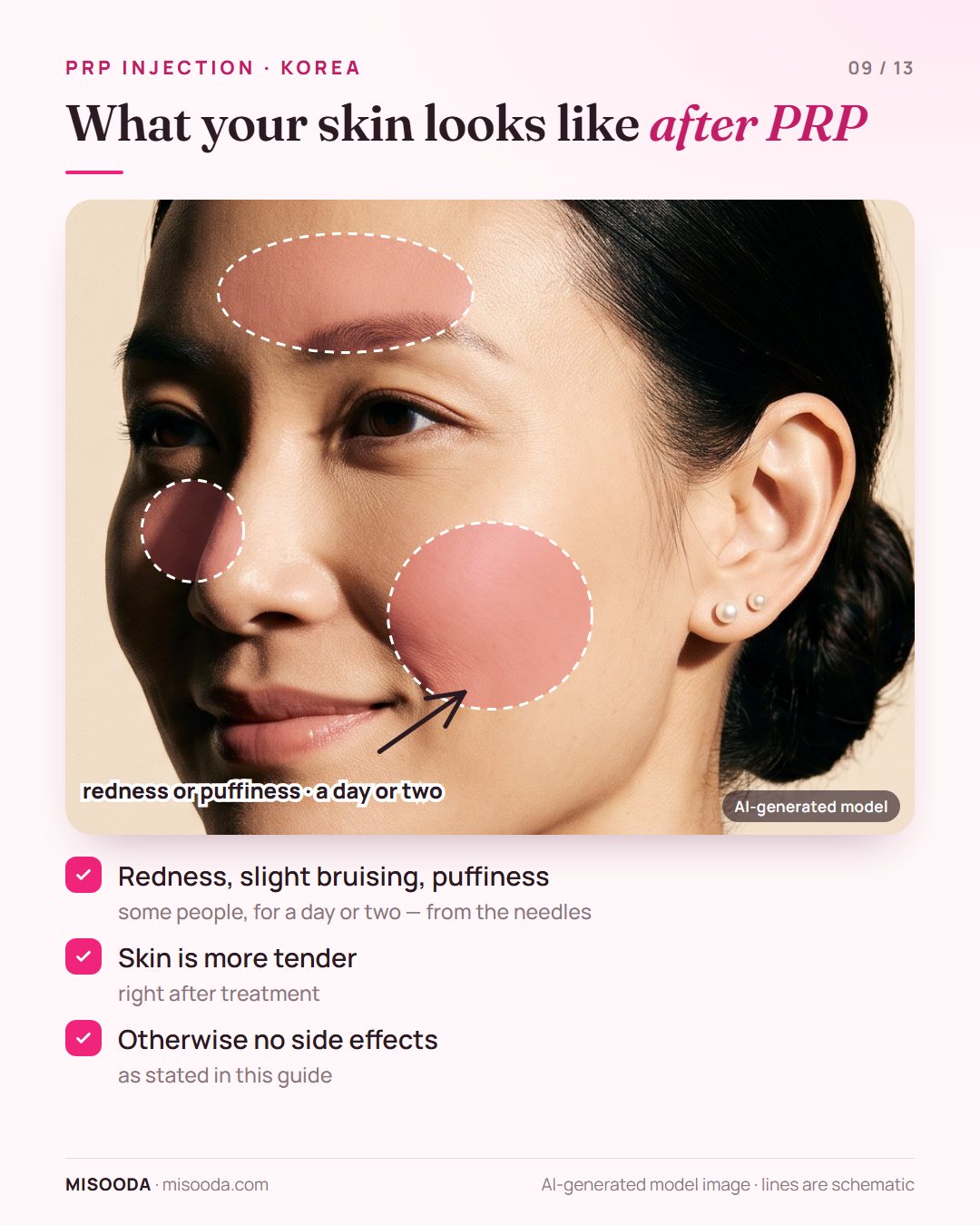 After a PRP injection some people have redness, slight bruising and puffiness for a day or two from the needles; skin is more tender