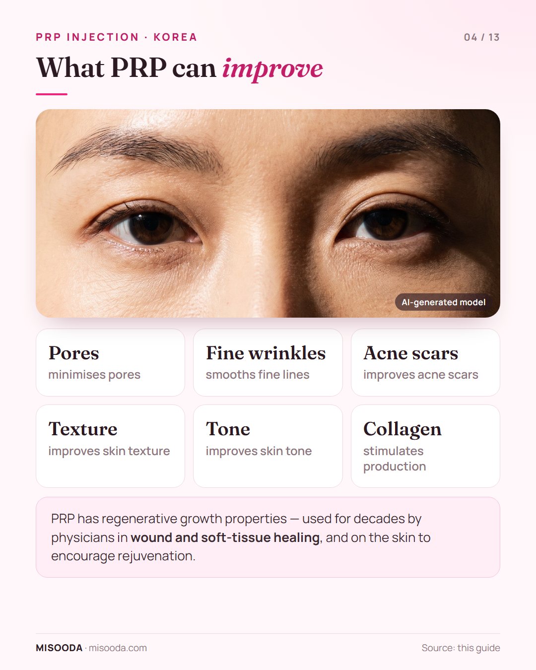 What PRP skin treatment improves: minimises pores, fine wrinkles and acne scars, improves skin texture and tone and stimulates collagen production
