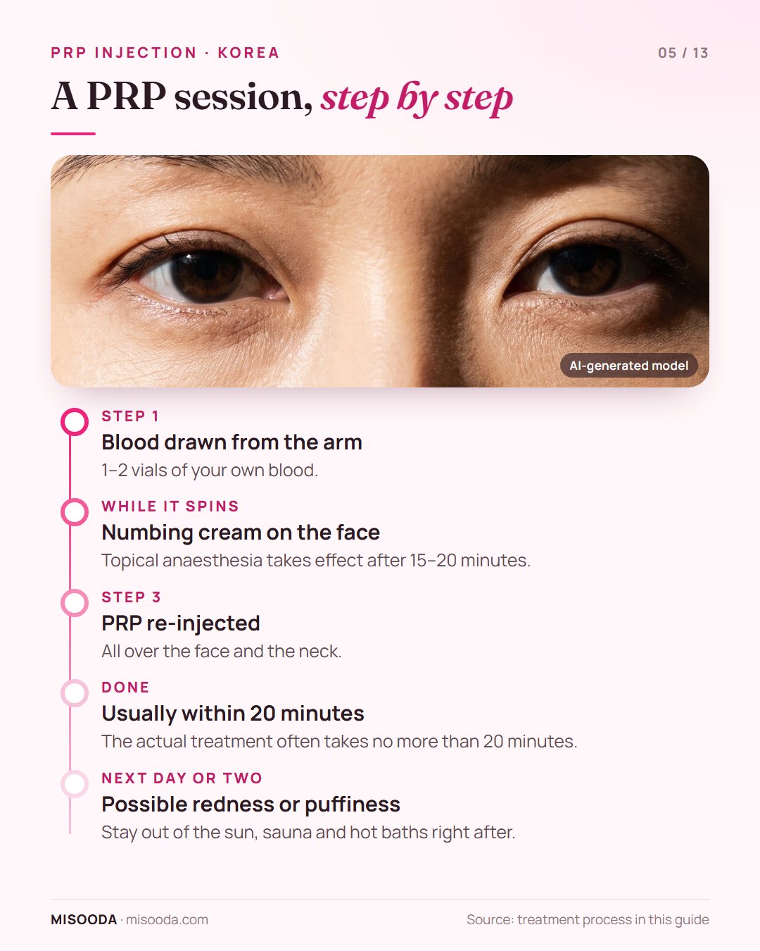 PRP treatment session timeline: blood drawn from the arm, numbing cream for 15–20 minutes, PRP re-injected into face and neck, done within 20 minutes