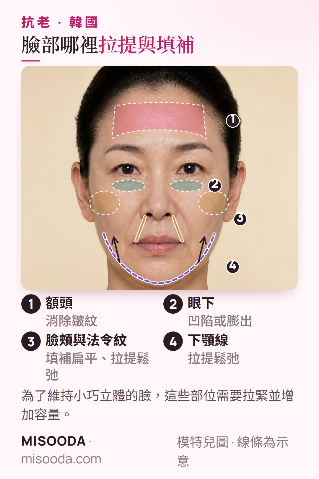 韓國 抗老療程臉部部位:額頭皺紋、眼下凹陷、臉頰與法令紋需填補,下顎線需拉提緊緻