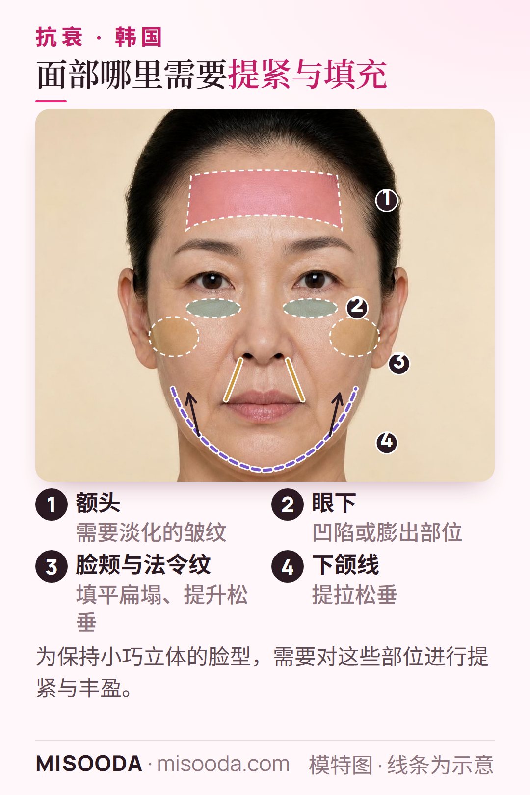 韩国 抗衰治疗面部部位:额头皱纹、眼下凹陷、需要填充的脸颊与法令纹,以及需要提拉紧致的下颌线