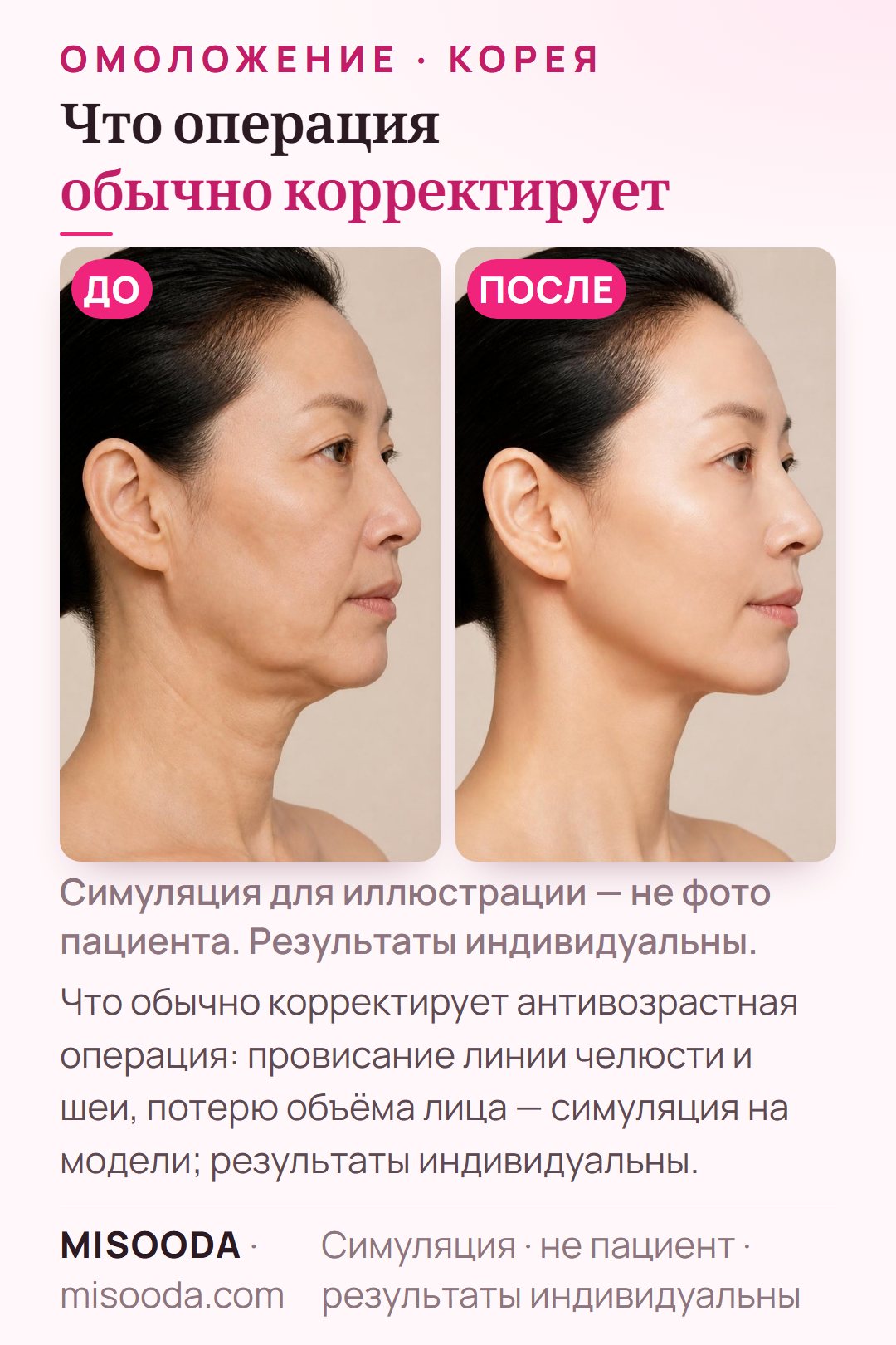 Иллюстрация типичных целей антивозрастной операции на лице в Корее — подтянутая линия челюсти, более гладкая шея и восстановленный объём — симуляция на модели, не пациент