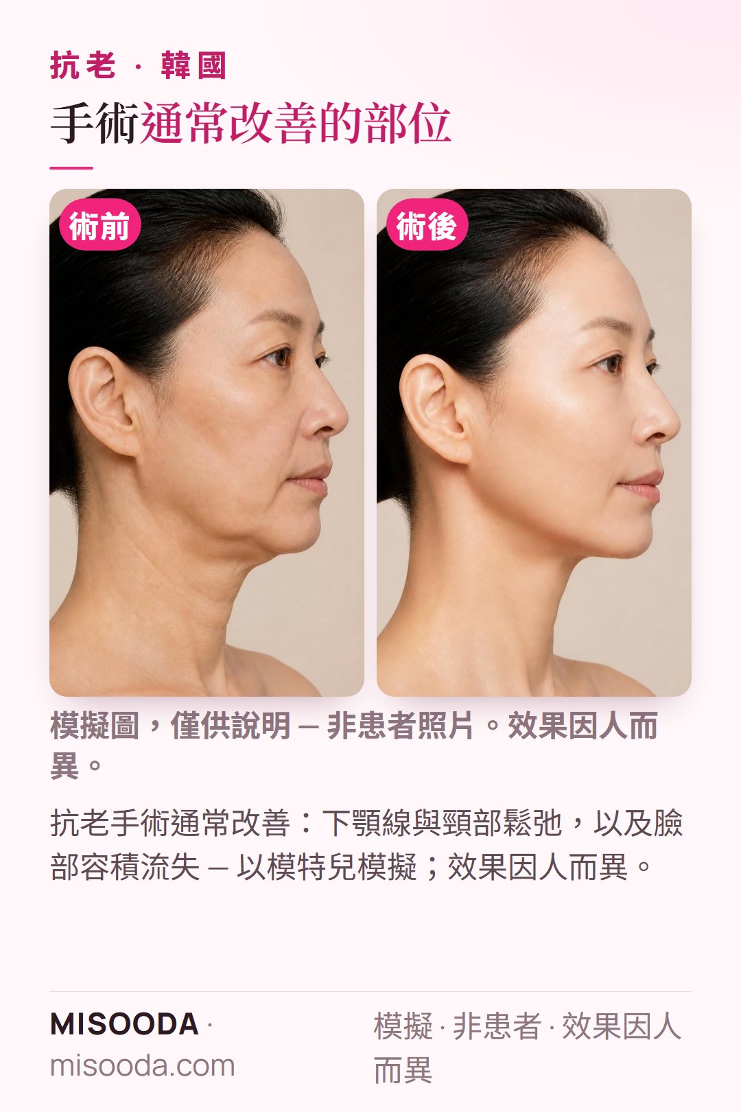 韓國臉部抗老手術常見目標示意圖 — 下顎線拉提、頸部更平滑、恢復臉部容積 — 以模特兒模擬呈現,並非真實患者照片,僅供了解手術希望改善的方向