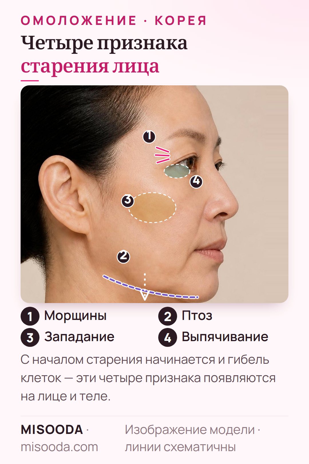 Антивозрастная хирургия в Корее: 4 главных признака старения в профиль — морщины вокруг глаз, провисшая линия челюсти, западания и выпячивания